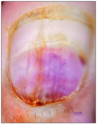 Onychomadesis with homogeneously coloured deep red-to-purple proximal subungual haematoma (Dermlite DL3N, x10).